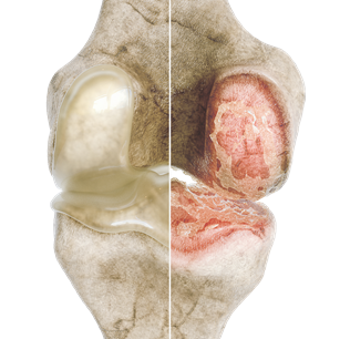 Comparaison cartilages arthrose