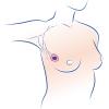 Tumorectomie mammaire